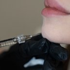 Косметолог виконує інʼєкції під час контурної пластики підборіддя