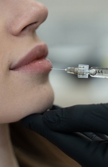 Косметолог виконує інʼєкції під час контурної пластики губ