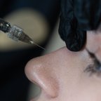 Косметолог виконує інʼєкції під час контурної пластики носа