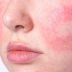 Лікування розацеа