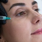 Інʼєкційна процедура для зволоження та омолодження шкіри