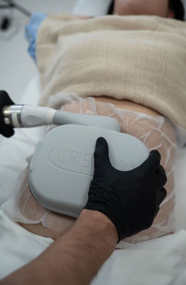 Процес видалення жирових відкладень методом кріоліполізу