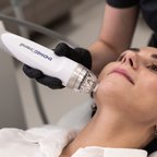 Процес омолодження шкіри за допомогою мікроголкової радіохвильової терапії