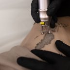 Процес видалення татуювання за допомогою сучасного лазера