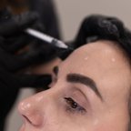 Ботулінотерапія — корекція зморшок, робота косметолога крупним планом