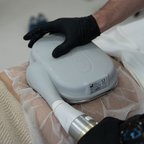 Кріоліполіз тіла — робота косметолога крупним планом