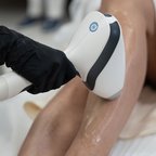 Процес лазерної епіляції шкіри — робота косметолога крупним планом