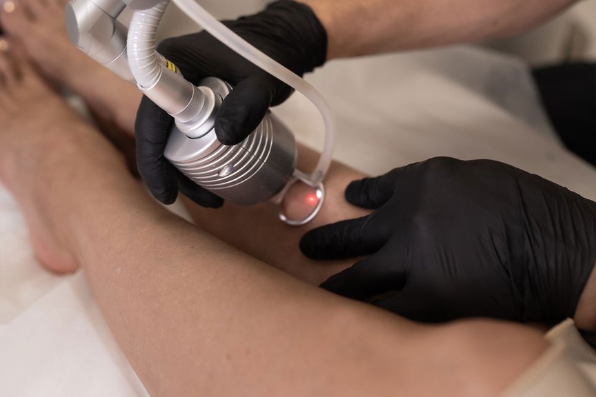 Лазерне видалення рубців — робота косметолога крупним планом