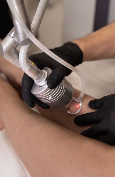 Лазерне видалення рубців — робота косметолога крупним планом