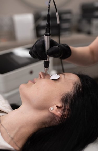 Лазерне видалення судин — робота косметолога крупним планом