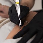 Видалення новоутворень — робота дерматолога крупним планом