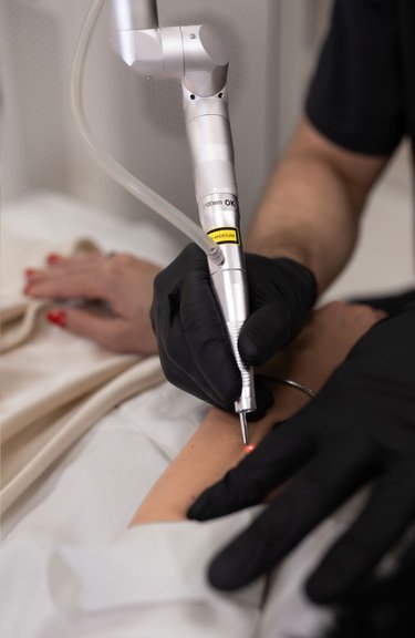 Видалення новоутворень — робота дерматолога крупним планом