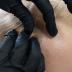 Консультація трихолога — обговорення діагностики та плану лікування